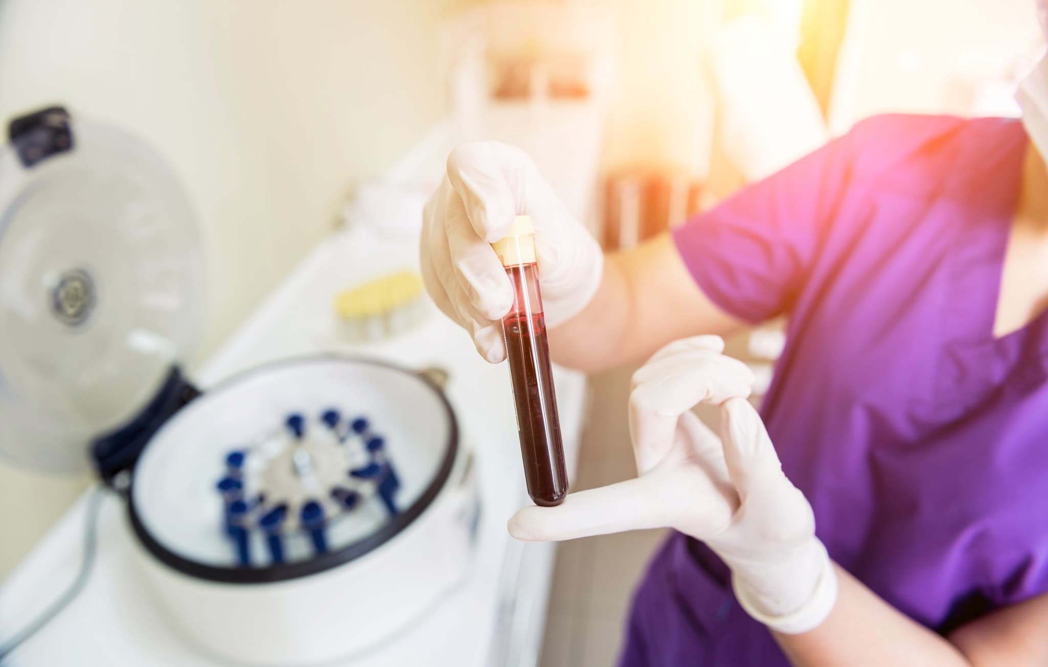 PRP treatment
