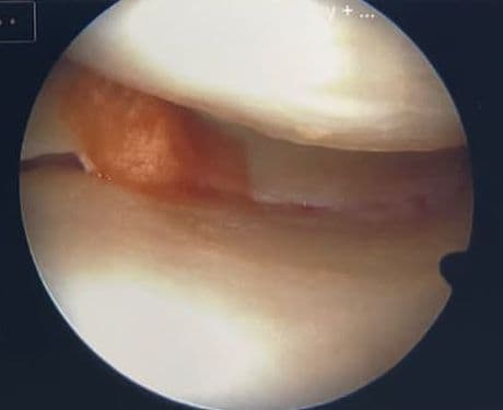 Interior view of joint during arthroscopic assessment